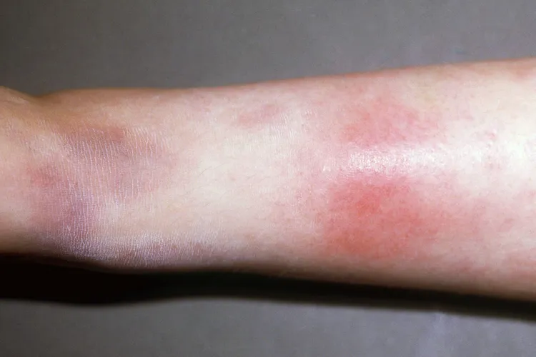 1800x1200_erythema_nodosum_on_leg_ref_guide