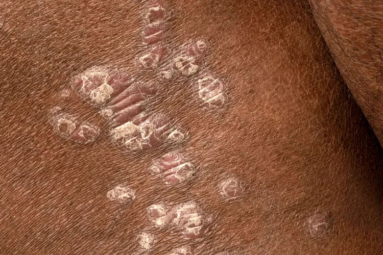 1800x1200_psoriasis_symptoms_causes_treatment_bigbead